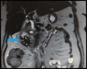 Gall Bladder